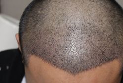 -大麦微针植发丨全国连锁