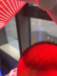 -碧莲盛·不剃发植发