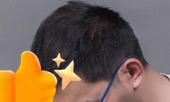 -大麦微针植发丨全国连锁