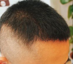 -大麦微针植发全国连锁