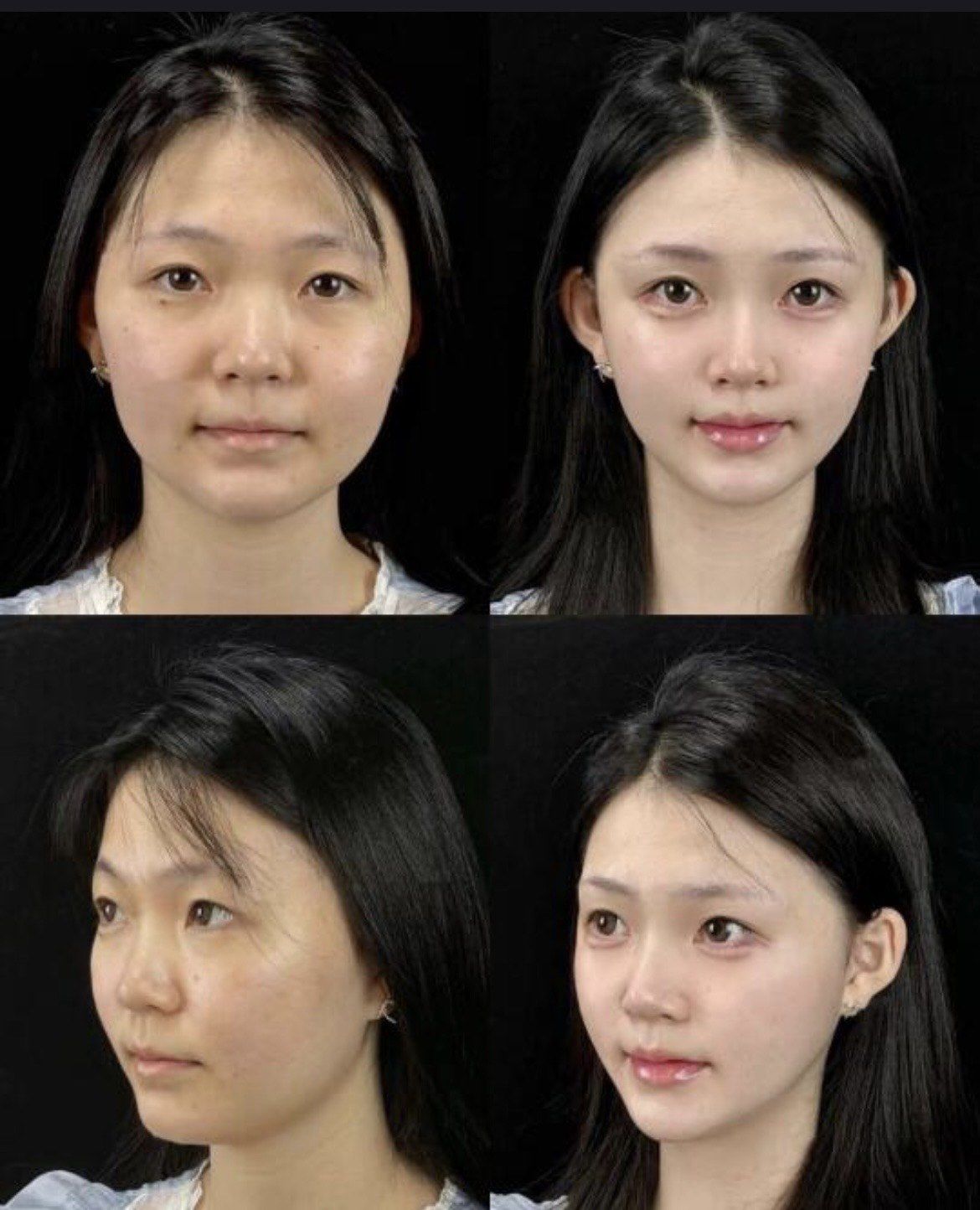 微整形小变化大