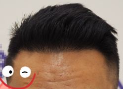 -大麦微针植发全国连锁
