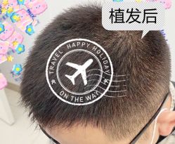 -大麦微针植发全国连锁