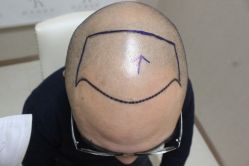 点击看大图 -大麦微针植发丨全国连锁