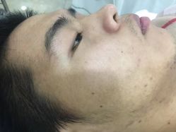 -悟空祛痘·诺奖技术专业店