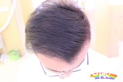 -大麦微针植发全国连锁