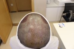 -大麦微针植发丨全国连锁