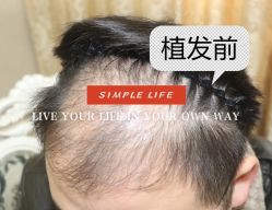 -大麦微针植发全国连锁
