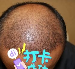 -大麦微针植发全国连锁
