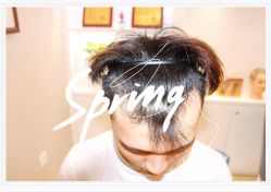 点击看大图 体验后-大麦微针植发全国连锁