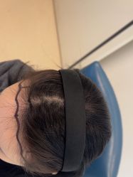 -大麦微针植发丨全国连锁