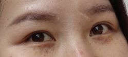 -爱莎扁平疣·汗管瘤·斑痣中心