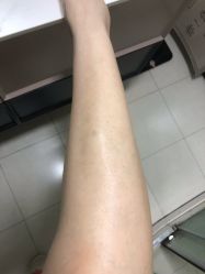 体验后-嘉和医学脱毛中心