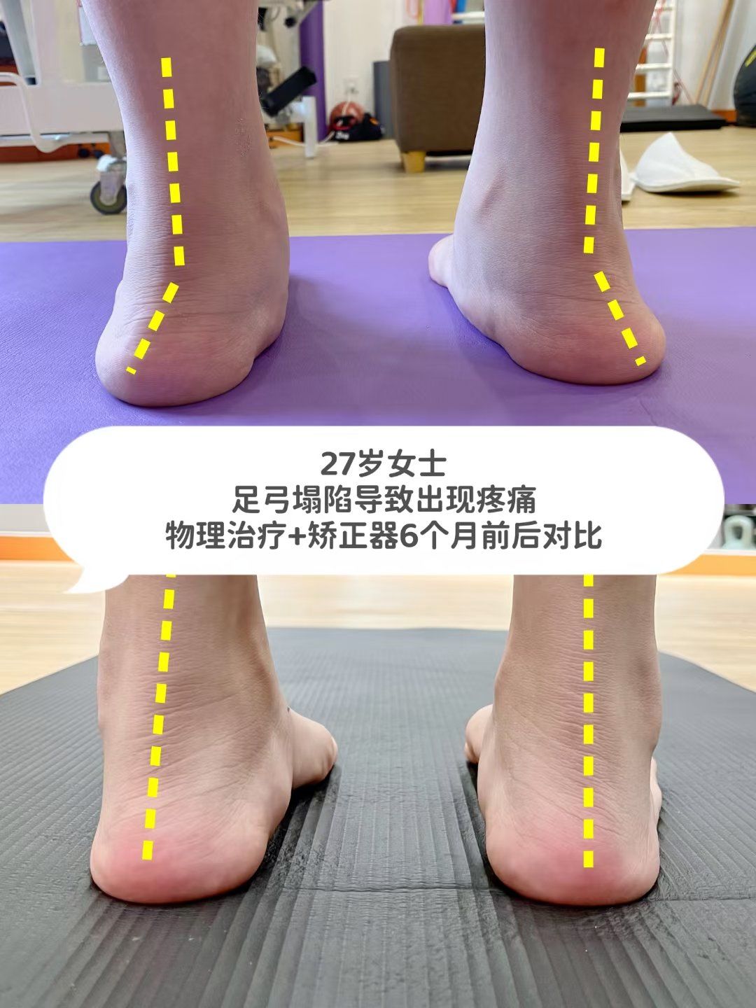 疼痛:长时间站立行走后疼痛加剧
足部疾病:易引起足底筋膜炎,跟腱炎