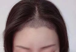 -大麦微针植发丨全国连锁