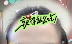 -大麦微针植发全国连锁