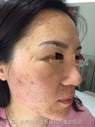 脸部抗衰-光SPA科技美肤