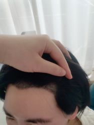-大麦微针植发丨全国连锁