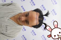 -大麦微针植发丨全国连锁