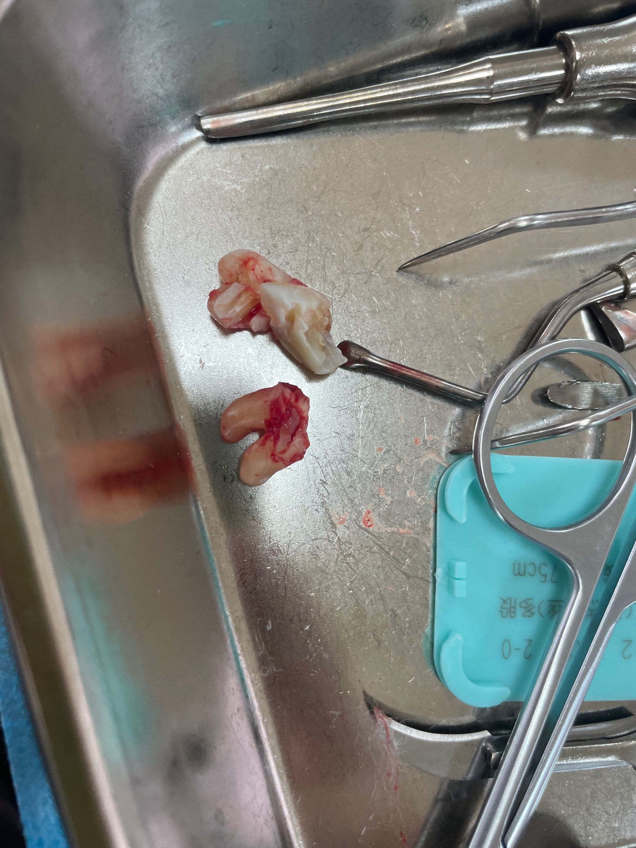 可惜自己没有,心态炸裂,阻生智齿有两颗,根管3