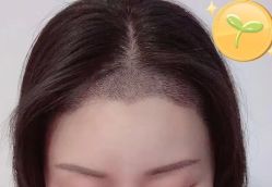 -大麦微针植发丨全国连锁