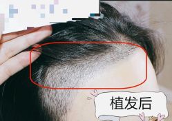 -大麦微针植发全国连锁