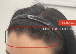 -大麦微针植发全国连锁