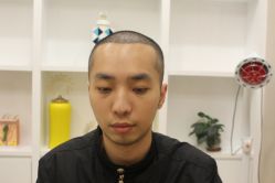 -大麦微针植发丨全国连锁