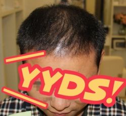 -大麦微针植发丨全国连锁