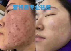 -蕾特恩专业祛痘·皮肤管理
