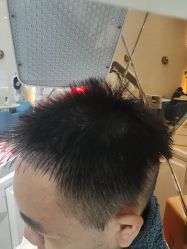 -碧莲盛·不剃发植发