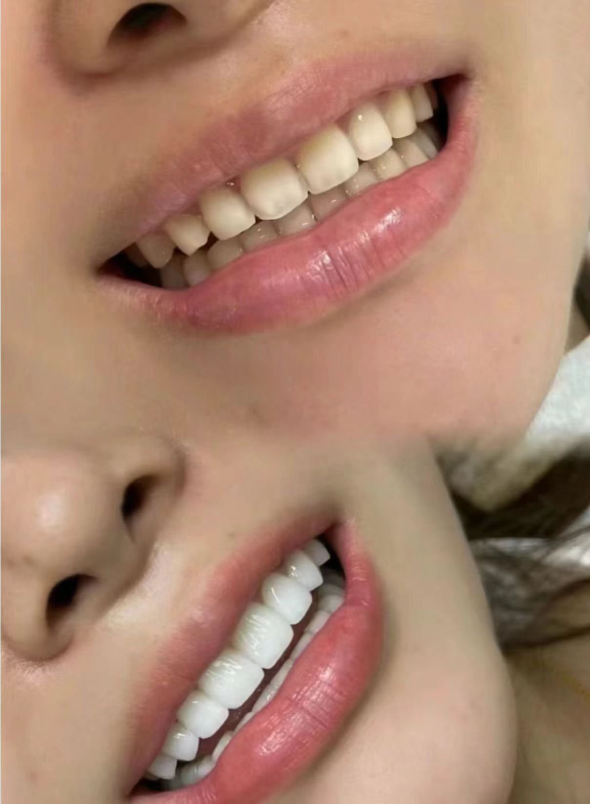 重获洁白整齐牙齿的秘诀是什么