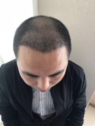 点击看大图 -大麦微针植发丨全国连锁