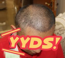 -大麦微针植发丨全国连锁