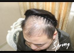 -大麦微针植发全国连锁