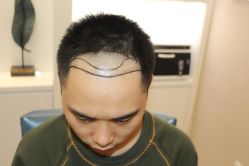 -大麦微针植发丨全国连锁