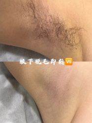 -薇兰专业脱毛连锁机构