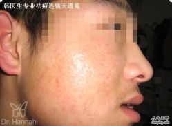 -韩医生专业祛痘连锁机构
