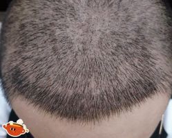 -大麦微针植发丨全国连锁