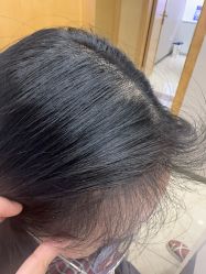 -大麦微针植发全国连锁
