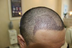 -大麦微针植发丨全国连锁