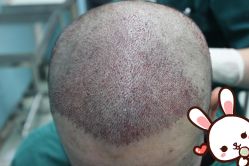 点击看大图 -大麦微针植发丨全国连锁