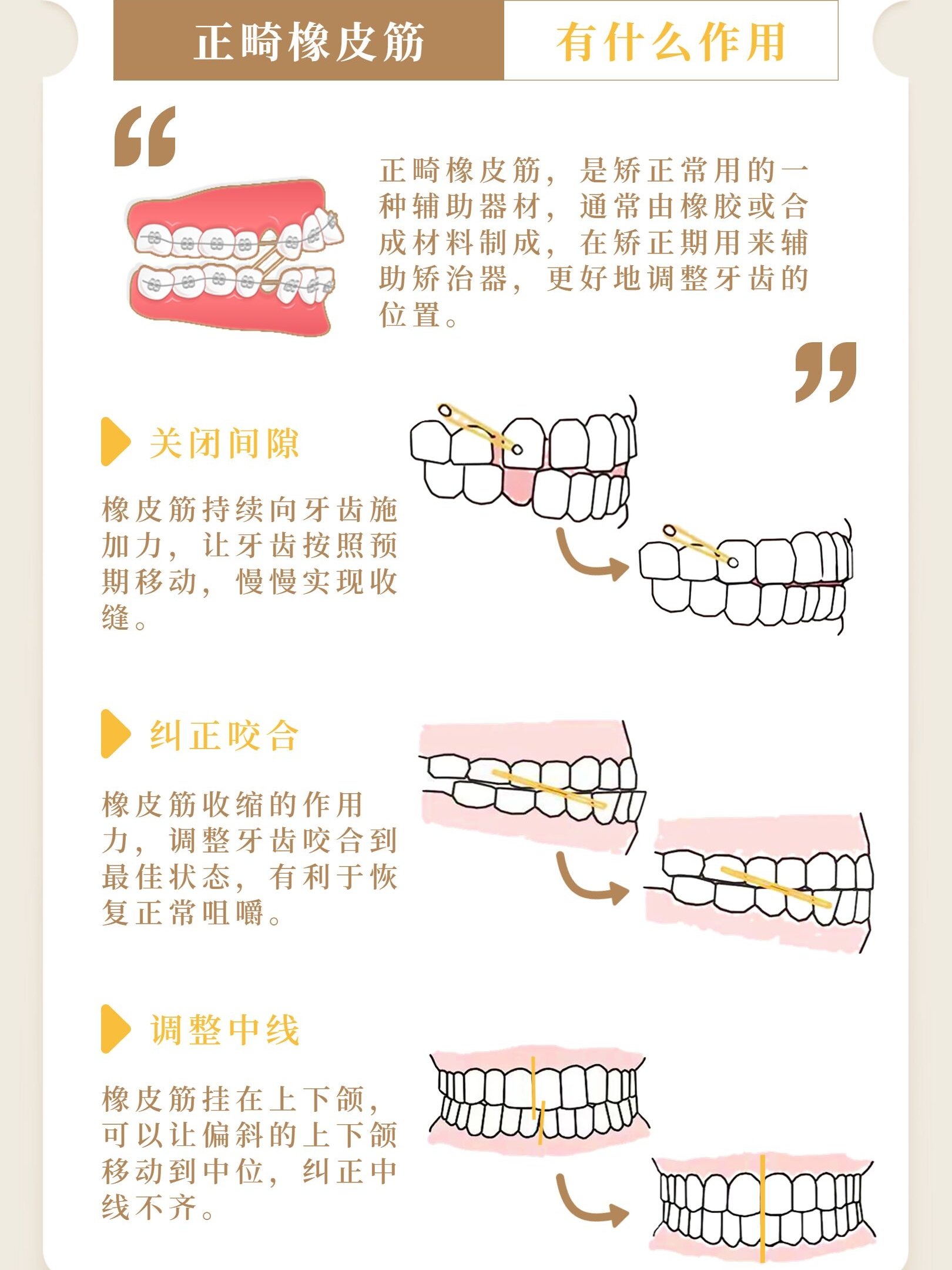 橡皮筋缠绕的方法图解图片