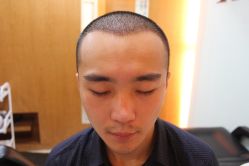 点击看大图 -大麦微针植发丨全国连锁