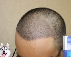 -大麦微针植发丨全国连锁