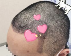 -大麦微针植发全国连锁