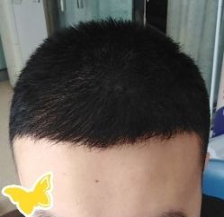 -大麦微针植发丨全国连锁