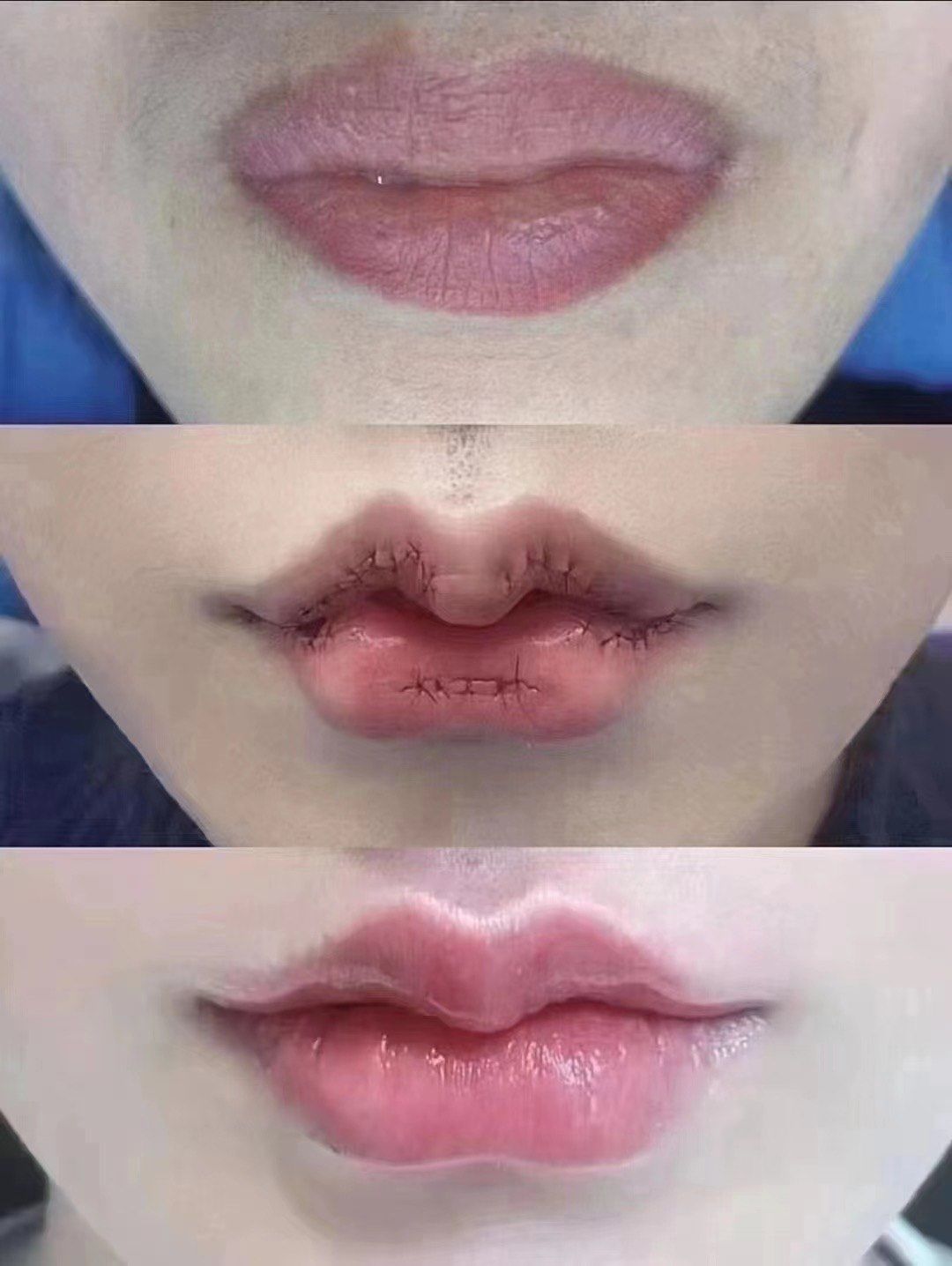 同乐医美,m唇案例