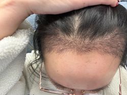 体验后-熙朵美学植发·连锁品牌