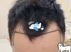 -大麦微针植发全国连锁